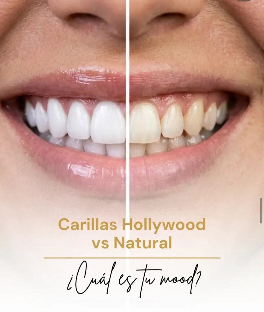 Comparación de carillas de cerámica estilo Hollywood y estilo natural