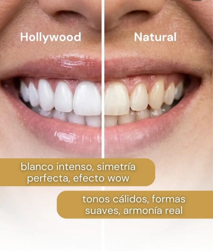 Primer plano de una sonrisa con carillas de aspecto natural