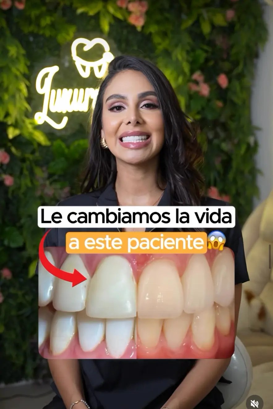 Antes y después de un caso de rehabilitación estética completa