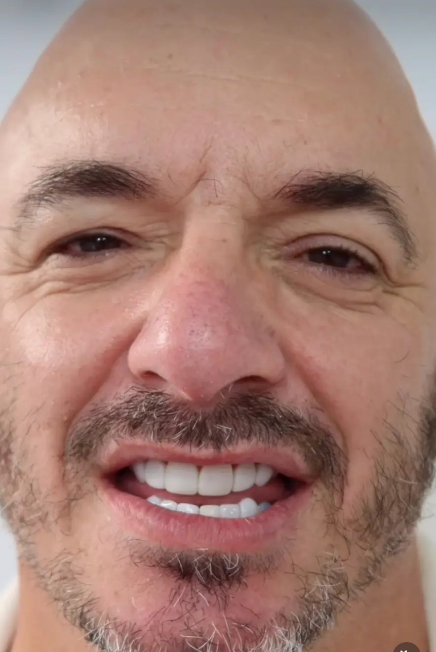 Después — Paciente internacional antes y después de su tratamiento estético dental