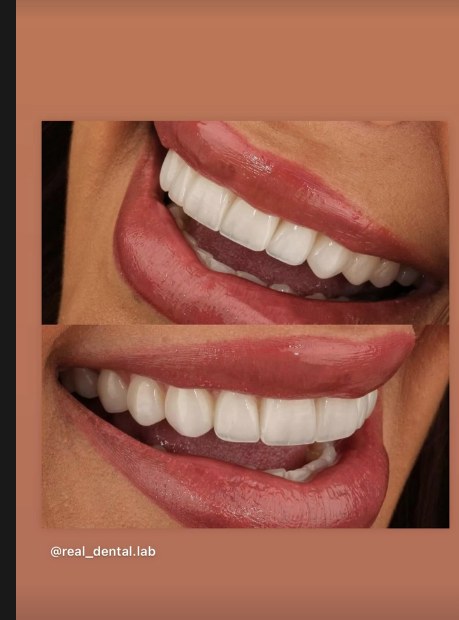 Detalle de sonrisas sanas después de una limpieza dental